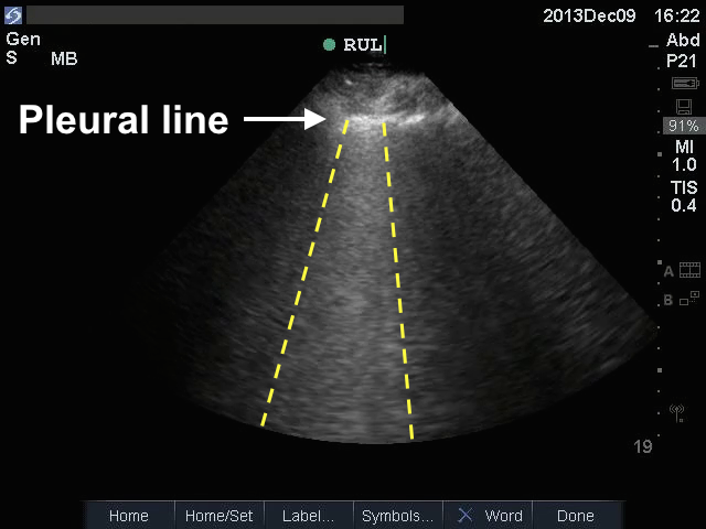 Teaching Medicine - Tutorial: Lung Ultrasound